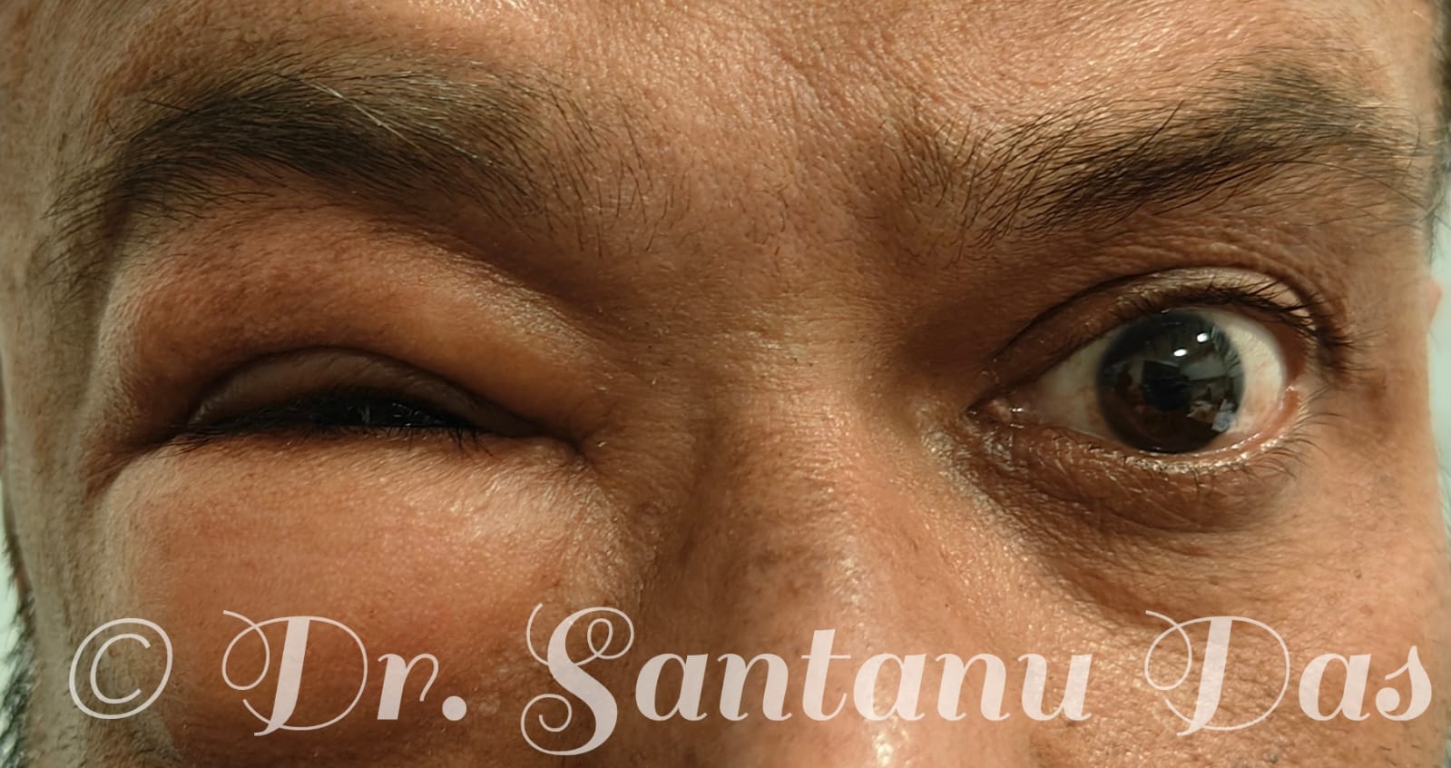 Periocular swelling post physical assault